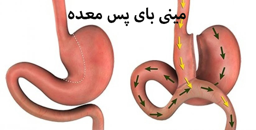 مینی بای پس معده