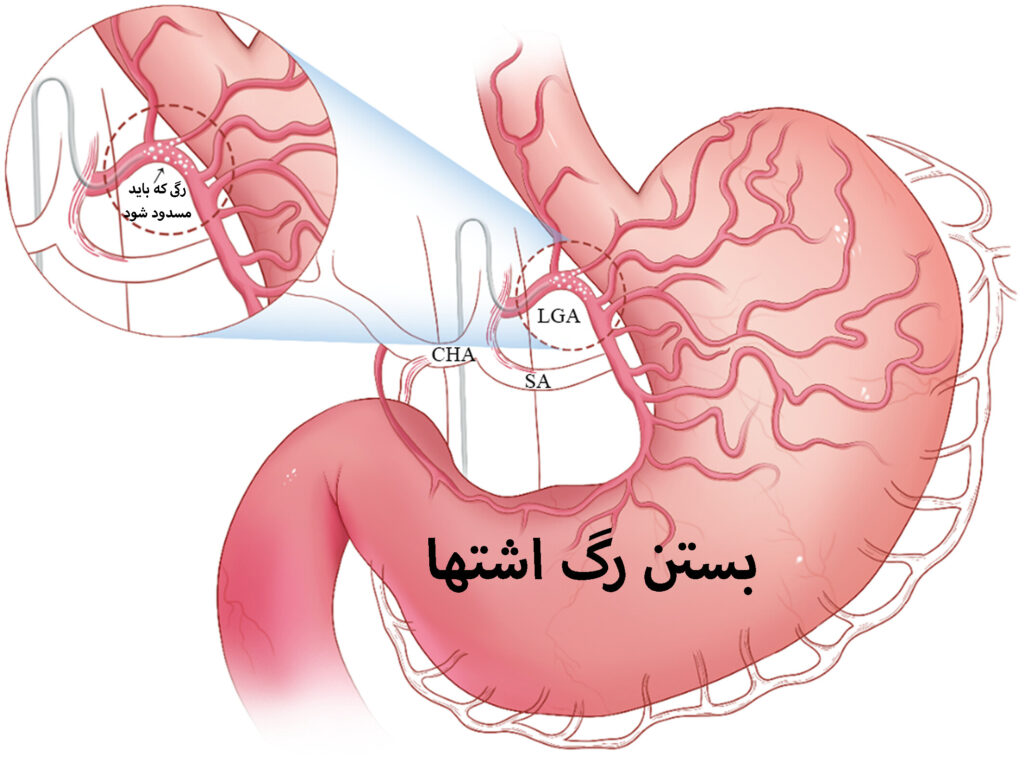 عمل بستن رگ اشتها