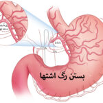 عمل بستن رگ اشتها