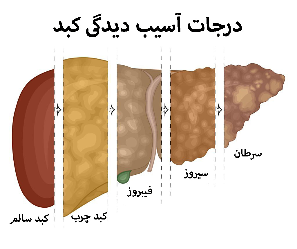 درجات آسیب دیدگی کبد