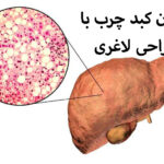 درمان کبد چرب با جراحی لاغری