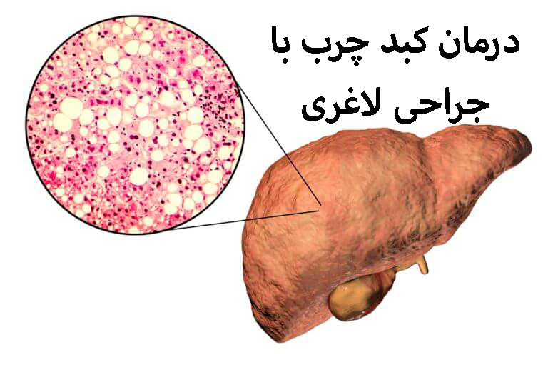 درمان کبد چرب با جراحی لاغری