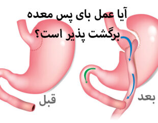 آیا عمل بای پس معده برگشت پذیر است؟