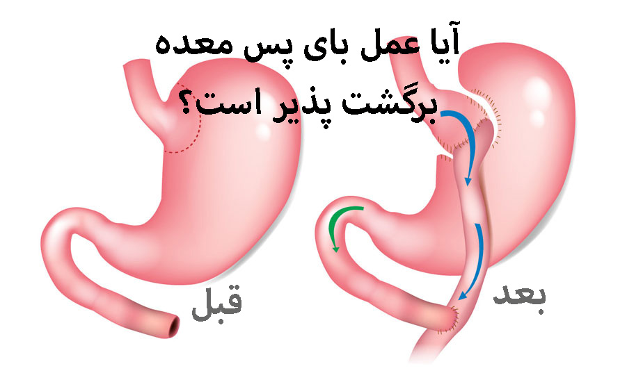 آیا عمل بای پس معده برگشت پذیر است؟